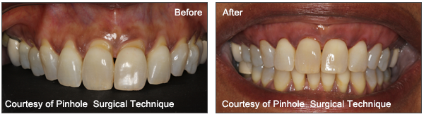 Patients Pinhole Surgical Technique Before And After results