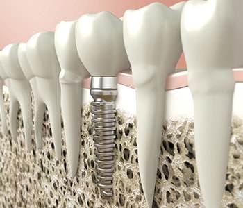 The benefits of dental implants