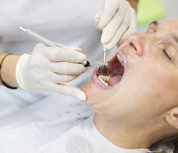 Professional cleaning removes dental plaque