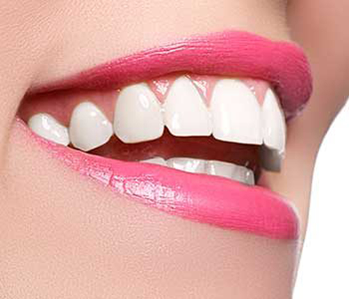 Many of those dazzling California smiles are the results of porcelain veneers