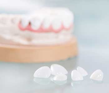Veneers in San Francisco benefit can enhance beauty and oral health