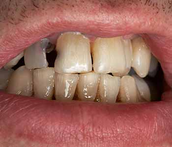 Understanding tooth decay in San Francisco