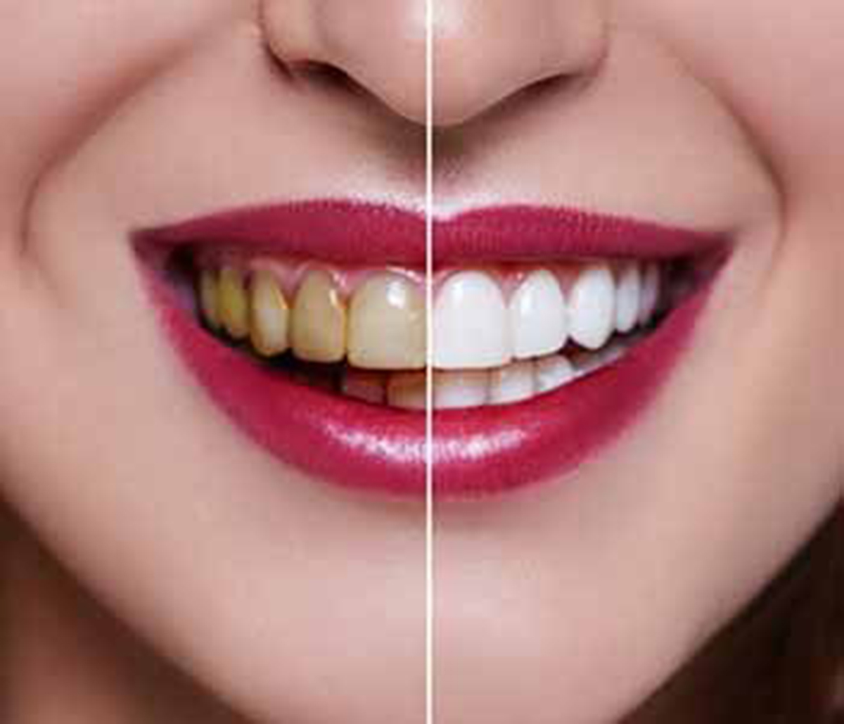 San Francisco, CA dentist, Dr. Arellano, is a dentist who offers professional whitening solutions for patients seeking cosmetic enhancement