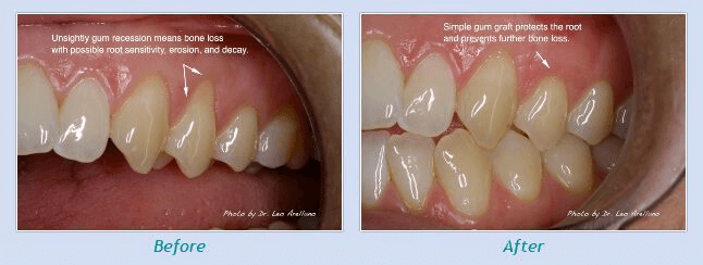 Gum Disease treatment Actual Patient Pictures Shown Before and After Treatment