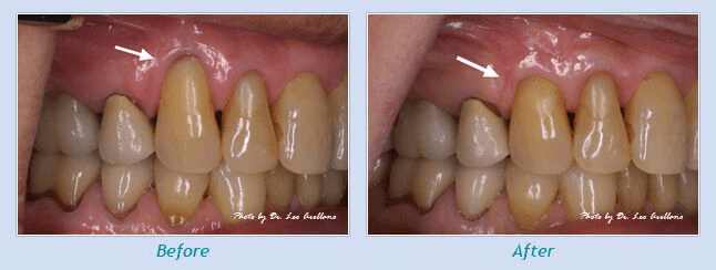 Gum Disease treatment Actual Patient Pictures Shown Before and After Treatment