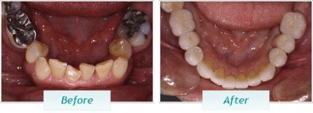 Gum Disease – BNA Image – 05-1