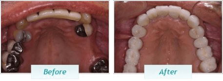 Gum Disease – BNA Image – 05