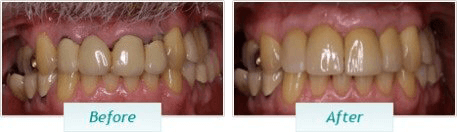 Dental Implants – BNA Image – 05