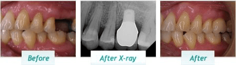 Dental Implants – BNA Image – 07