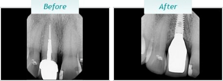 Dental Implants – BNA Image – 10-1
