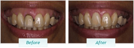 Dental Implants – BNA Image – 10