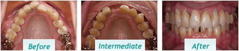 Dental Implants – BNA Image – 11-1
