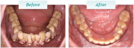 Dental Implants – BNA Image – 12-1
