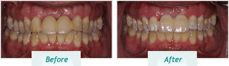 Teeth Whitening – BNA Image – 01