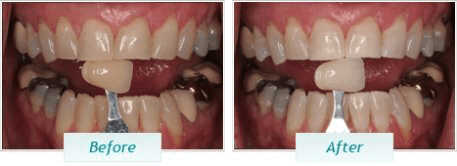 Teeth Whitening – BNA Image – 05