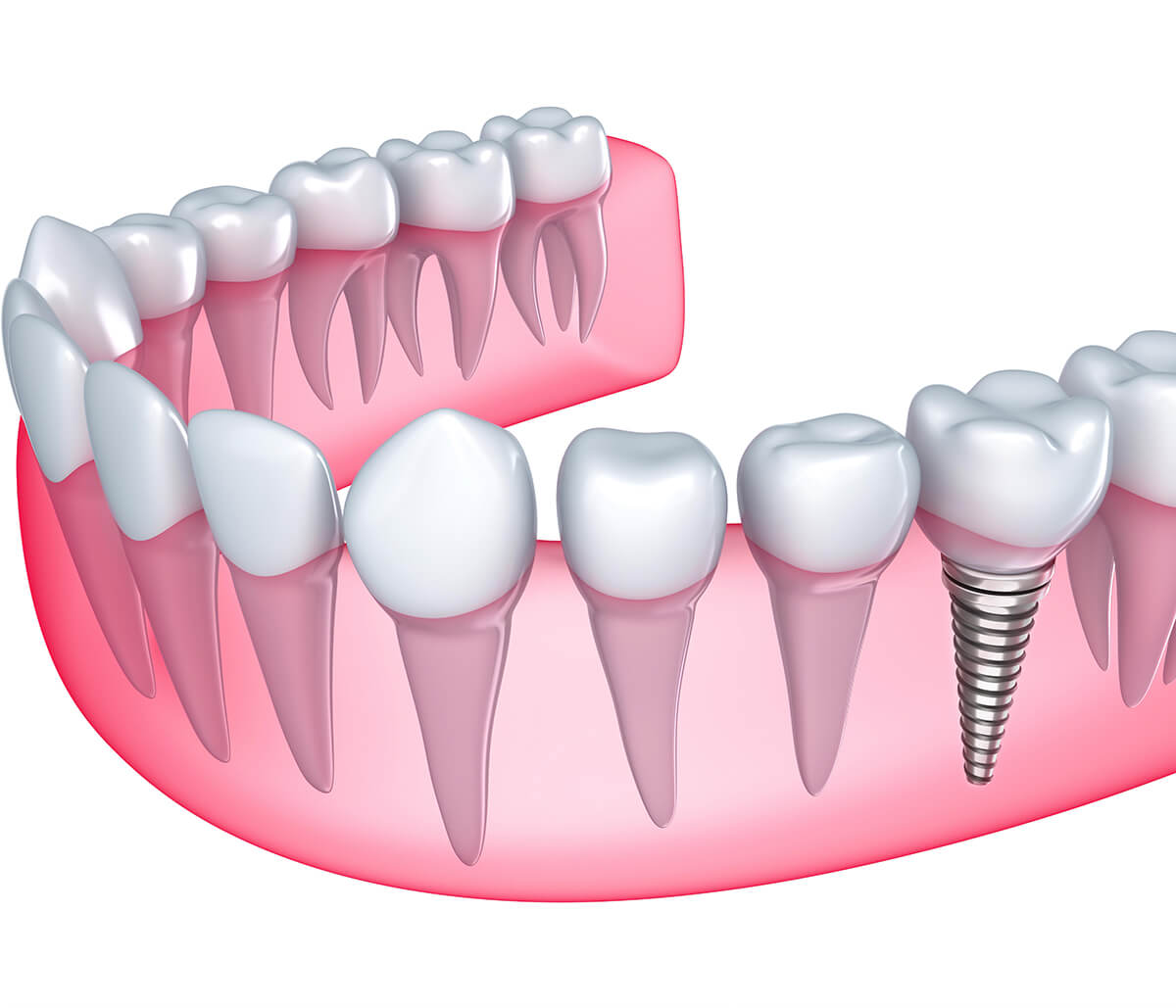 Dental Implant Restoration in San Francisco Area